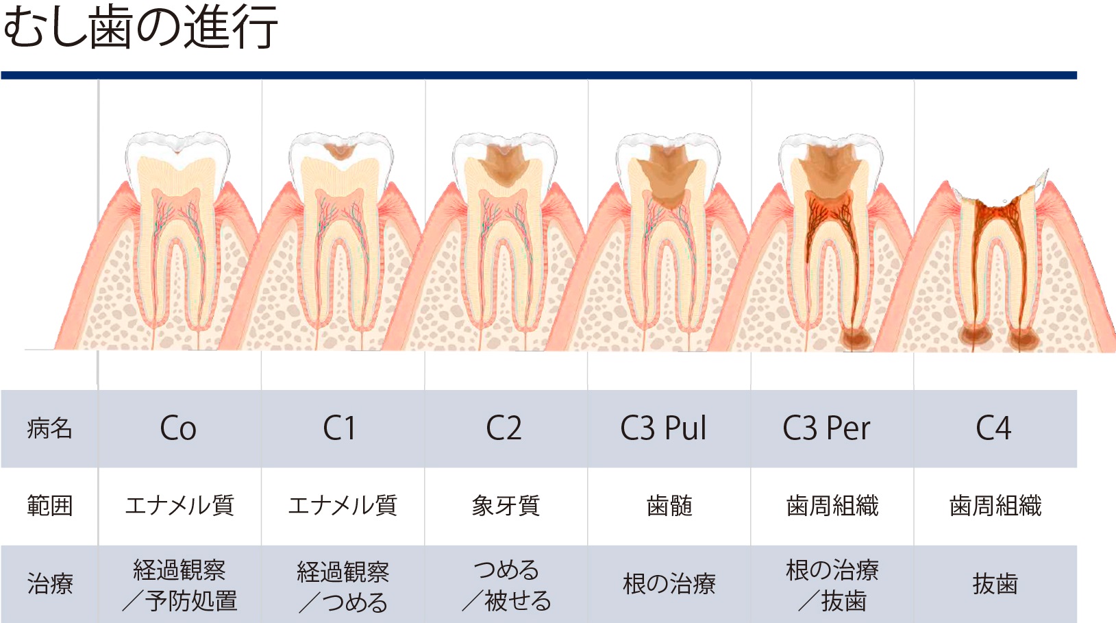 むし歯の進行