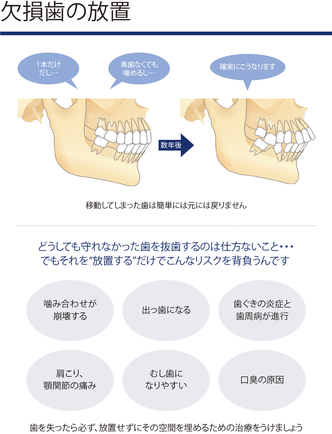 欠損歯の放置