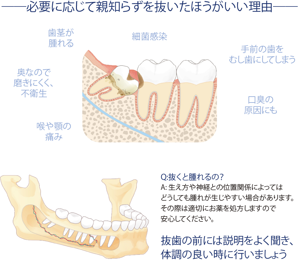 親知らず 抜歯 喉 痛い