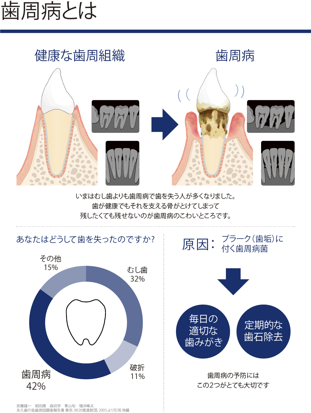 歯周病とは