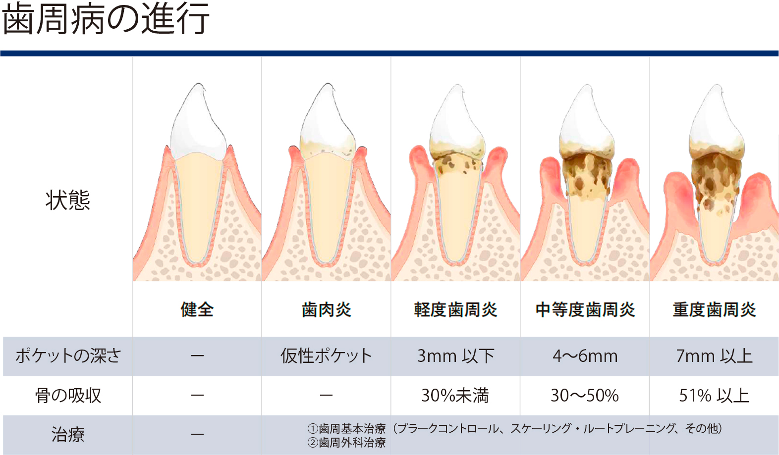 歯周病の進行