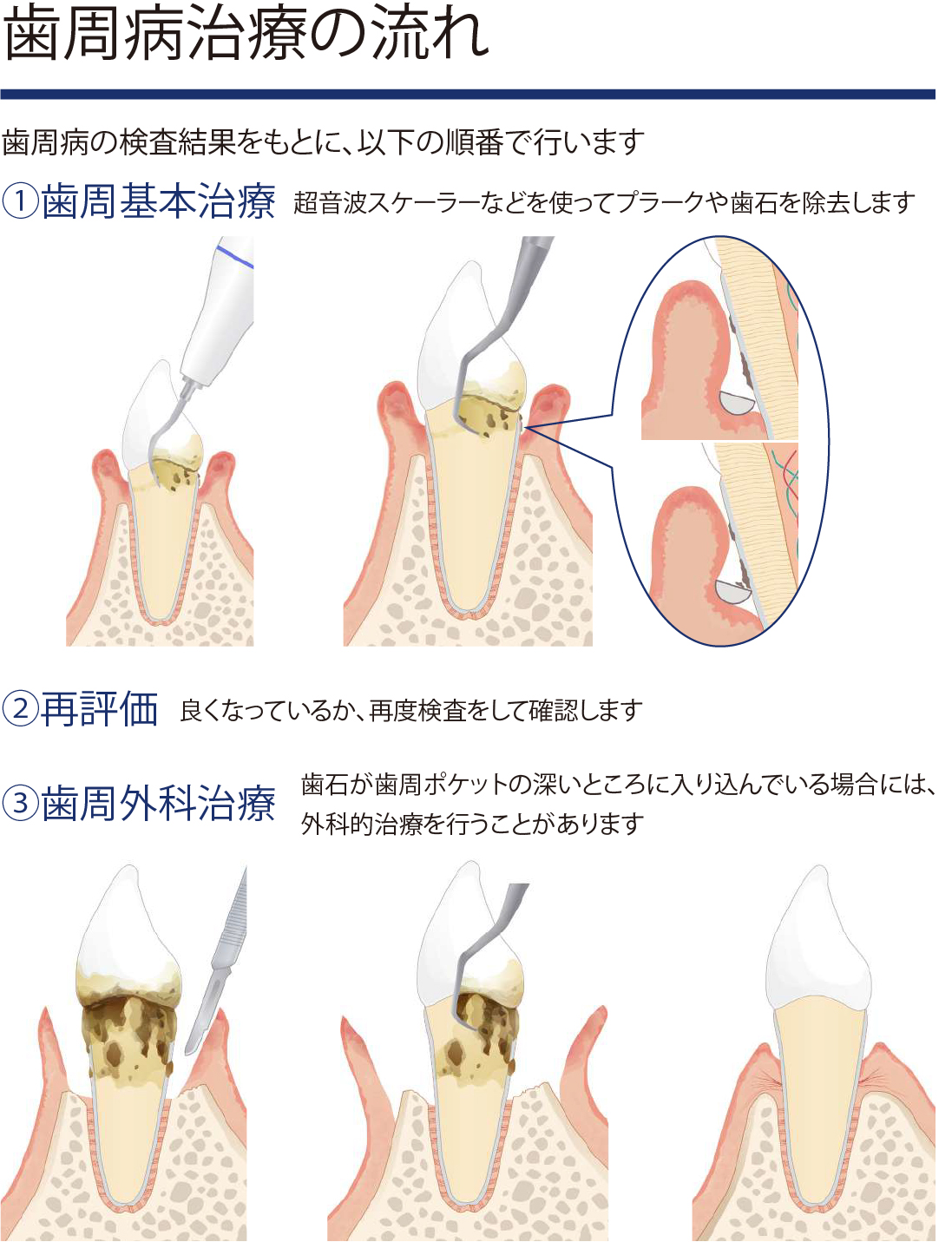 歯周病治療の流れ